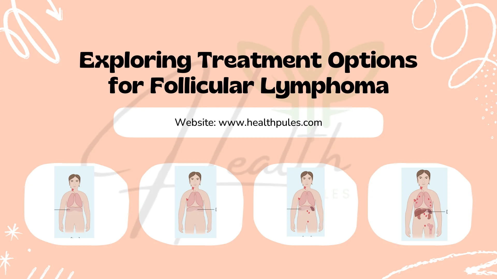 Follicular Lymphoma